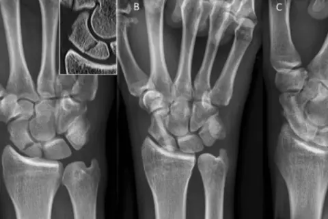 Radiografías de mano que muestran el escafoides. La imagen A es una vista anteroposterior, B una vista lateral y C una vista oblicua.