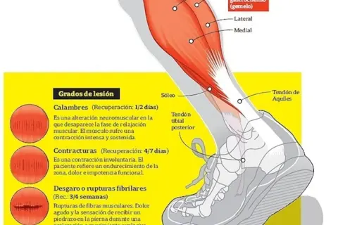 Ilustración de la anatomía de la pierna, detallando el músculo sóleo y los grados de lesión muscular, como desgarros.