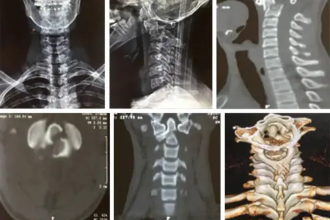 Radiografías y tomografías de columna cervical, mostrando la apófisis odontoides y posibles fracturas.