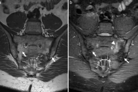 Resonancia sacroiliaca: imagen (a) muestra hallazgos normales, mientras que (b) revela inflamación y edema en la articulación sacroiliaca izquierda (flechas y triángulo).