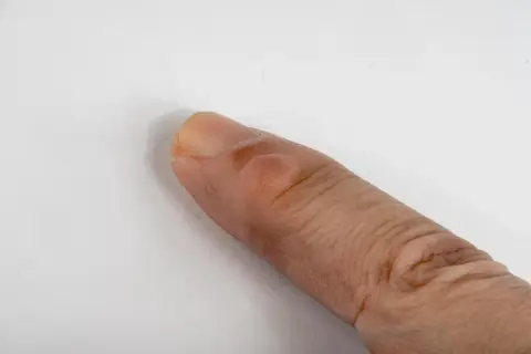 Un dedo con bolitas en los dedos de las manos, posiblemente una ampolla o un callo.