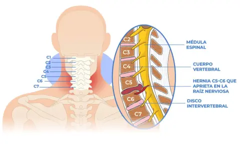 Ilustración de la columna cervical con hernia C5-C6 que causa cervicobraquialgia derecha.