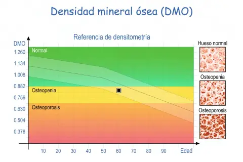 Gráfico de densitometría ósea que muestra la relación entre DMO y edad, con zonas de normalidad, osteopenia y osteoporosis.
