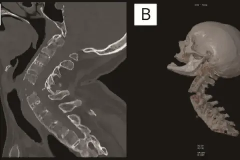 Corte sagital y reconstrucción 3D de columna cervical mostrando una grave fractura cervical.