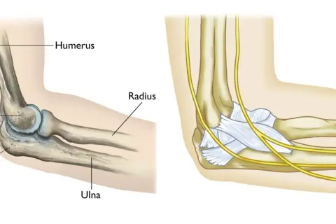Ilustración anatómica del codo, mostrando el húmero, radio, cúbito y olecranon. La imagen de la derecha detalla nervios y ligamentos, útil para entender una fractura olecranon.