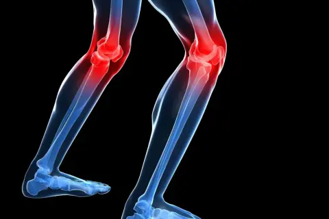 Ilustración de unas piernas con las rodillas en rojo, indicando dolor. De repente me falla la rodilla al caminar.