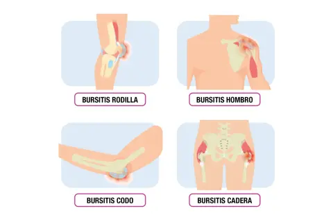 Ilustraciones de bursitis en rodilla, hombro, codo y cadera, mostrando inflamación en las articulaciones.