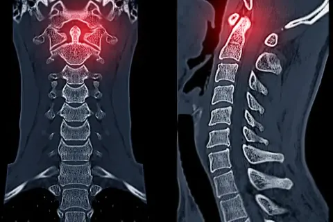 TAC cervical muestra una lesión en las vértebras superiores, resaltada en rojo.