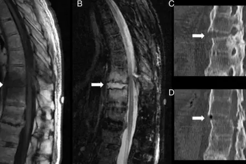 Resonancia magnética y tomografía de columna vertebral. La resonancia muestra cambios degenerativos, indicativos de artrosis lumbar.