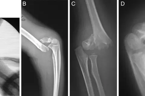 Radiografías de codo muestran una fractura supracondilea con desplazamiento y fragmentación ósea, indicando una lesión compleja.