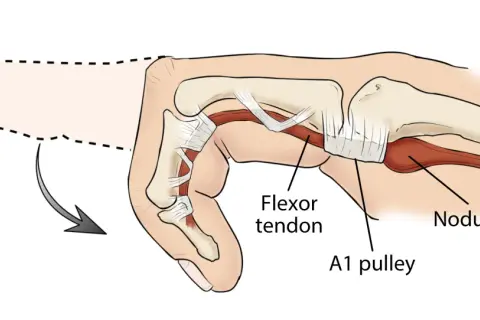 Anatomía del dedo en gatillo: un tendón flexor engrosado y un nódulo impiden el movimiento suave a través de la polea A1.