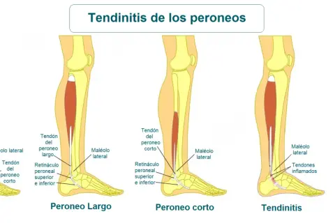 Ilustración de la anatomía del tobillo y la pierna, mostrando el tendón peroneo lateral largo y la tendinitis.