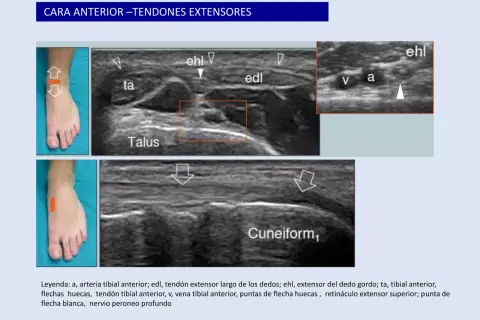 Ecografía del tobillo: muestra tendones extensores, arteria y vena tibial anterior, y el nervio peroneo profundo.