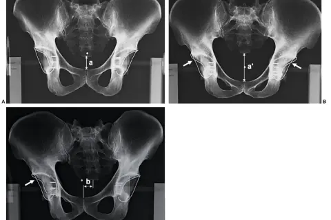 Radiografía de cadera que muestra mediciones y fijaciones. La imagen A compara la distancia 'a'. La imagen B muestra la distancia 'a'' y la flecha indica un implante. La imagen C muestra la distancia 'b' y una flecha señala un implante.