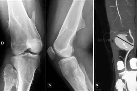 Radiografías y TC de rodilla que muestran un osteocondroma. La imagen c revela un aneurisma de 63,5 mm.