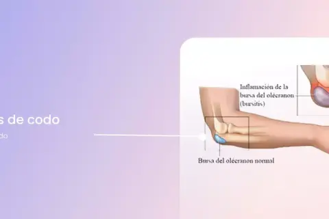 Ilustración de la bursitis de codo, mostrando la inflamación de la bursa del olécranon.