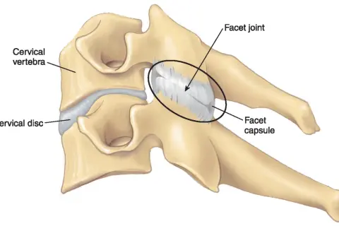 Ilustración de vértebras cervicales y disco, destacando la articulación facetaria y su cápsula, relevante para entender la sinovitis facetaria.