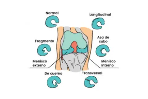 Ilustración de rodilla con diferentes tipos de lesiones meniscales, incluyendo el cuerno posterior del menisco interno.
