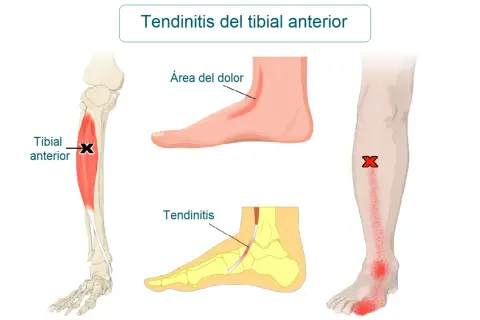 Ilustración médica que muestra la tendinitis tibial anterior, con el músculo tibial anterior marcado y áreas de dolor en el pie y la espinilla.