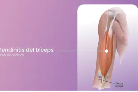 Ilustración de la tendinitis del bíceps, mostrando el tendón del bíceps y el dolor de hombro asociado.