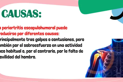 Causas de la periartritis escapulohumeral: golpes, contusiones, sobreesfuerzo o falta de movilidad del hombro. Ilustración de un hombro con dolor.