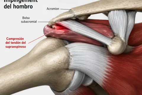 Ilustración anatómica del **impingement subacromial** en el hombro, mostrando la compresión del tendón del supraespinoso.