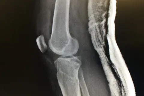 Radiografía de rodilla con fractura de meseta tibial, indicando el grado de discapacidad.