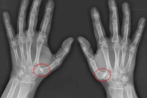 Radiografías de ambas manos mostrando rizartrosis grados avanzados en la base del pulgar, con deformidad ósea y estrechamiento articular.