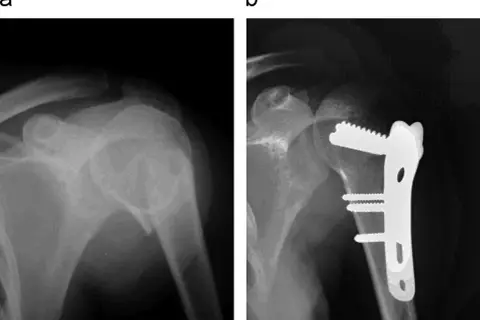 Radiografía muestra fractura humero proximal antes y después de la cirugía con placa y tornillos.