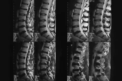 Imágenes de resonancia magnética de la rm columna dorsal, mostrando vértebras y discos intervertebrales.