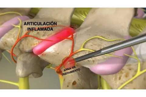 Ilustración de articulación interapofisaria inflamada y su tratamiento.
