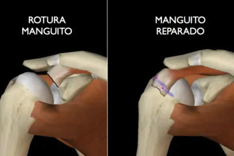 Comparación de un manguito rotador roto con uno reparado, mostrando cómo el manguito rotador se cura solo.