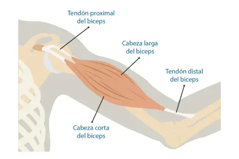 Anatomía del bíceps, mostrando tendón proximal, cabeza larga y corta, y tendón distal. Ilustra la zona donde puede ocurrir una rotura de bíceps.