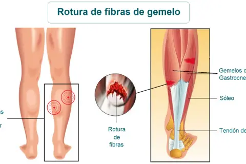 Ilustración de las secuelas de rotura fibrilar gemelo, mostrando zonas de dolor y detalle de la rotura.