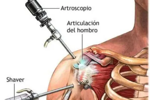 Ilustración de artroscopia de hombro para tratar una luxación glenohumeral. Se ven un artroscopio y un shaver.