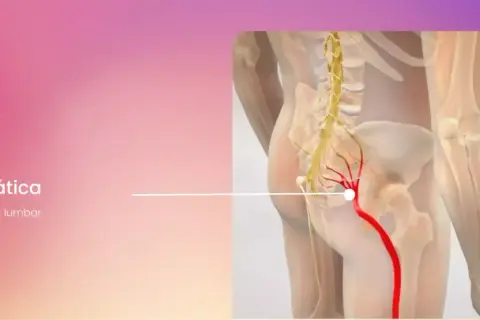 Ilustración de ciática, mostrando dolor lumbar derecho irradiado hacia adelante a lo largo del nervio ciático.