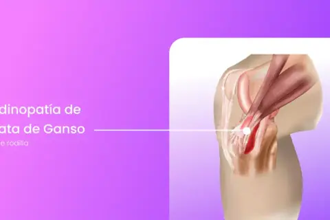 Ilustración de la tendinopatía de la pata de ganso en la rodilla, mostrando la inflamación y el dolor. El tratamiento es clave.