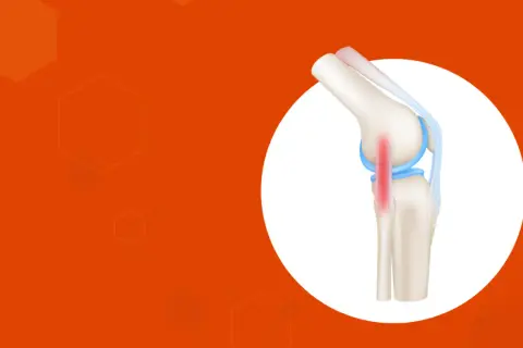 Ilustración de rodilla con tendinitis en el ligamento lateral externo, marcada en rojo.