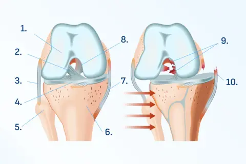Ilustración de rodilla sana y lesionada. La imagen de la derecha muestra una rotura de ligamentos, causando dolor al apoyar la rodilla en el suelo.