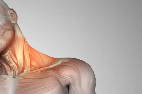 Anatomía del cuello con los escalenos musculos resaltados en rojo, indicando posible tensión o dolor.