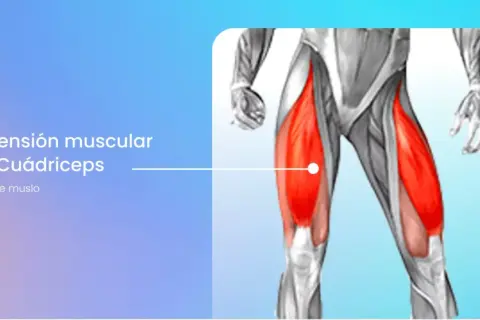 Anatomía del cuádriceps con el vasto interno inflamado, indicando dolor de muslo.