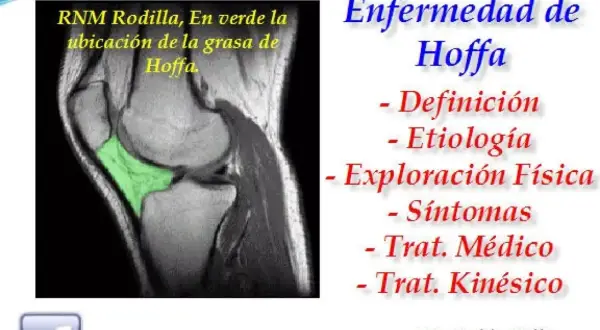 RM de rodilla que muestra la grasa de Hoffa en verde. Enfermedad de Hoffa: definición, etiología, exploración, síntomas y tratamiento.
