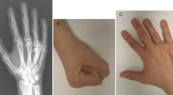 Radiografía de mano (A) mostrando un hueso metacarpiano fracturado, un puño cerrado (B) y una mano abierta (C).