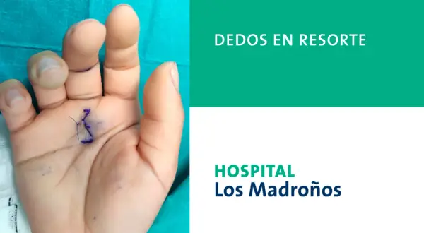 Mano con marca para cirugía de dedo en resorte. Ecografía muestra la mano de un paciente con marcas quirúrgicas en la palma y los dedos, indicando el tratamiento para el dedo en resorte.