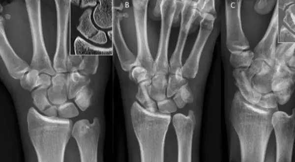 Radiografías de mano que muestran el escafoides. La imagen A es una vista anteroposterior, B una vista lateral y C una vista oblicua.