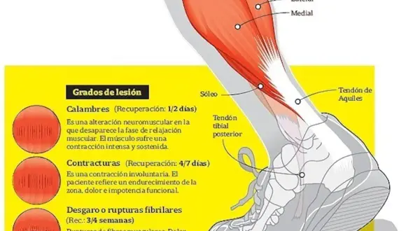 Ilustración de la anatomía de la pierna, detallando el músculo sóleo y los grados de lesión muscular, como desgarros.