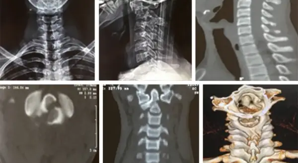 Radiografías y tomografías de columna cervical, mostrando la apófisis odontoides y posibles fracturas.