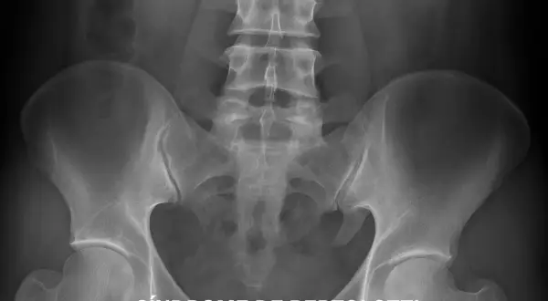 Radiografía pélvica que muestra la sacralización de L5, una anomalía vertebral que puede causar dolor lumbar.