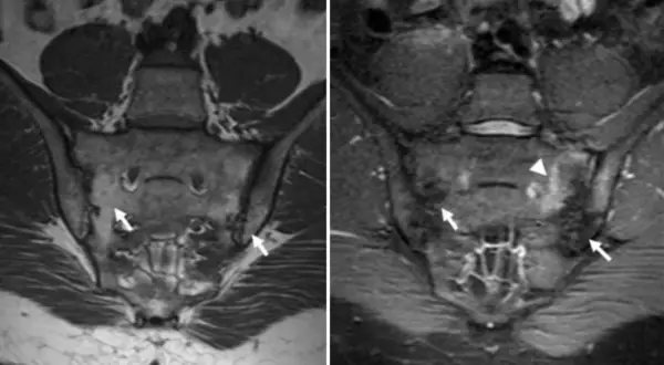 Resonancia sacroiliaca: imagen (a) muestra hallazgos normales, mientras que (b) revela inflamación y edema en la articulación sacroiliaca izquierda (flechas y triángulo).