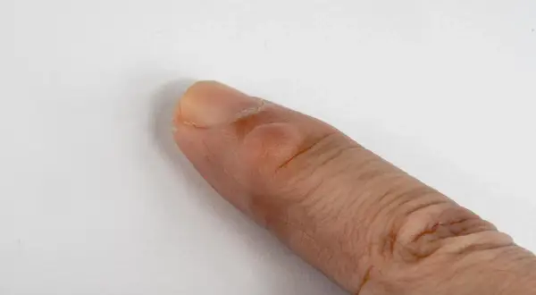 Un dedo con bolitas en los dedos de las manos, posiblemente una ampolla o un callo.